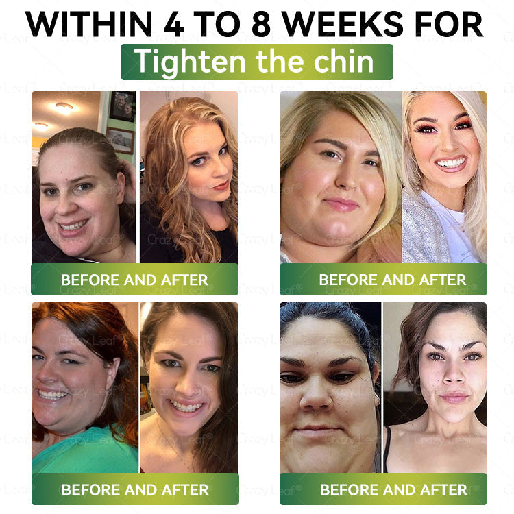 UK Clinically Proven|Official Store | CrazyLeaf® SMGT-GLP-1 Nano Microneedle Patch with Collagen & Matrixyl 3000 丨Targets Obesity, Loose Skin, High Blood Pressure, Diabetes, Fatty Liver, Joint Pain, Brain Fog, Low Energy, Body Aches, and More